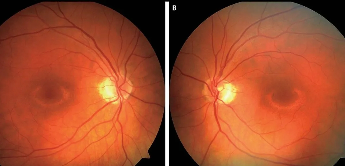 Plaquenil Eye Exam - Nova Eyecare